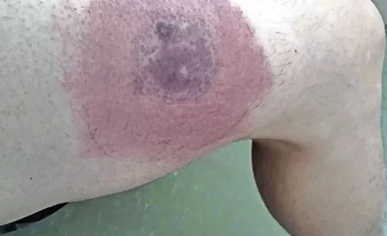 Suman 153 casos de ataques de animales ponzoñosos en el estado