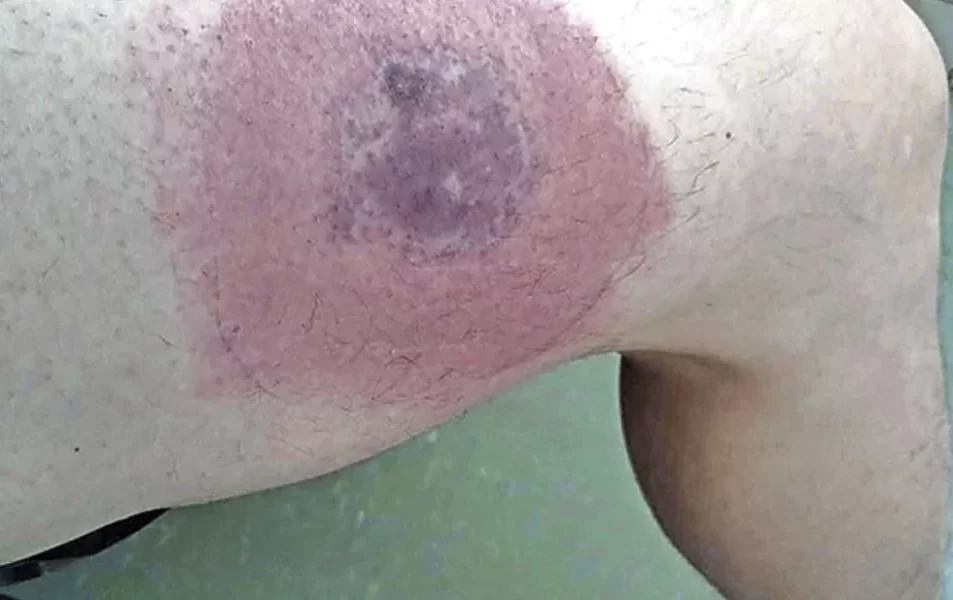 Suman 153 casos de ataques de animales ponzoñosos en el estado