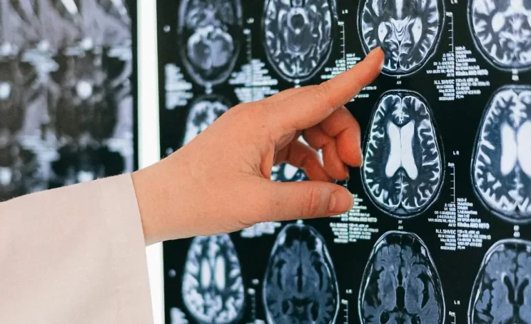 Entre 2024 y 2025, se detectan 6 casos de tumores cerebrales malignos al mes en Chihuahua