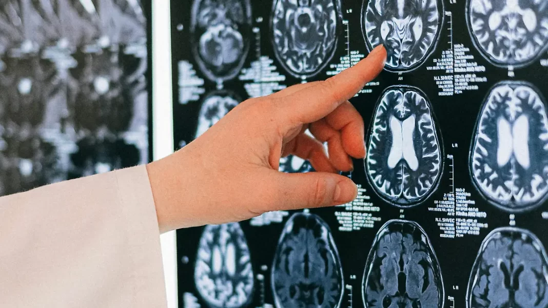 Entre 2024 y 2025, se detectan 6 casos de tumores cerebrales malignos al mes en Chihuahua